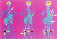 肺の腺癌の患者のポジトロン断層画像